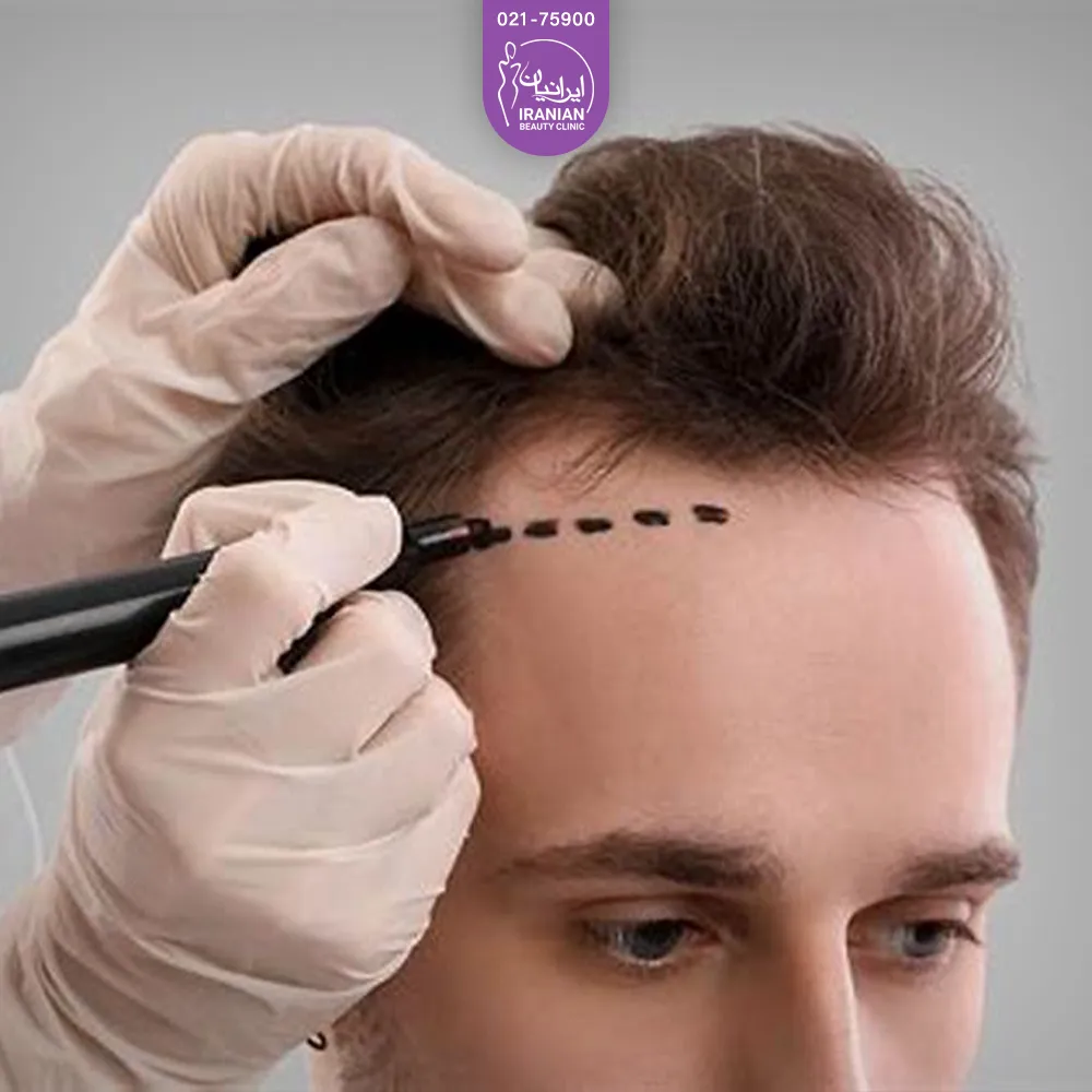 فردی که نشسته و دستان دکتری که با ماژیک در ناحیه شقیقه او خط چین کشیده است - کاشت مو شقیقه