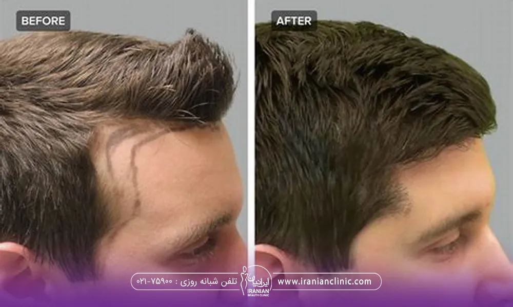 عکس قبل و بعد پسری که کاشت موی شقیقه انجام داده است