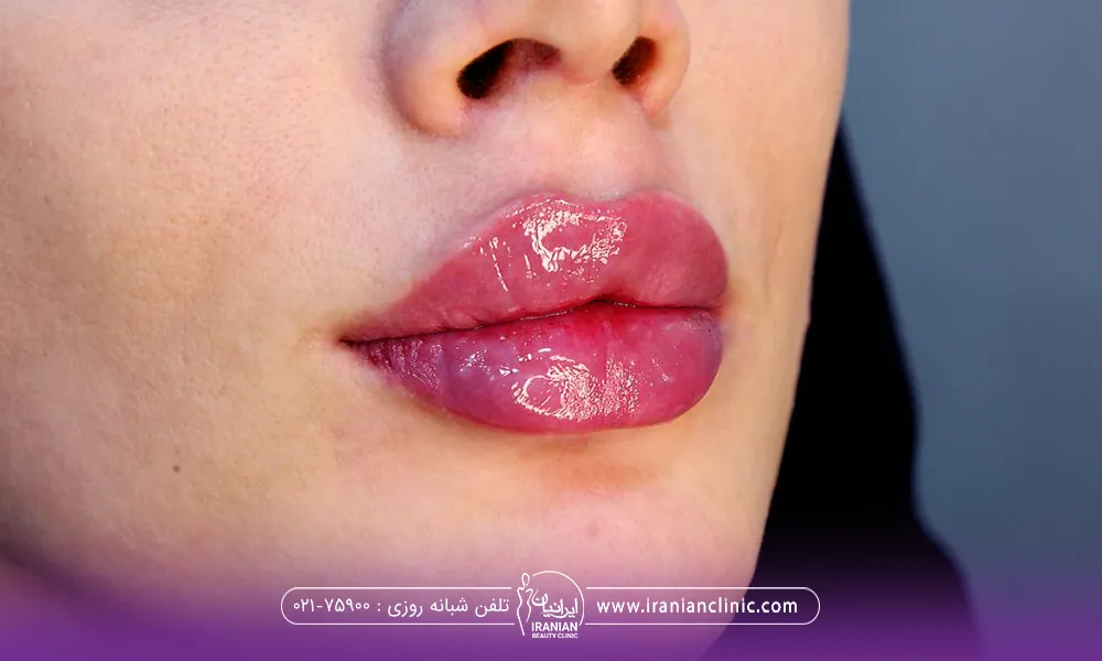 عکس لب های حجیم دختر که تزریق ژل روسی انجام داده است