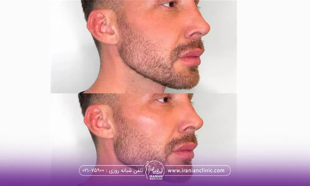 عکس قبل و بعد زاویه سازی فک مردانه