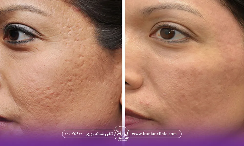 عکس قبل و بعد دختری که سابسیژن جای جوش انجام داده است