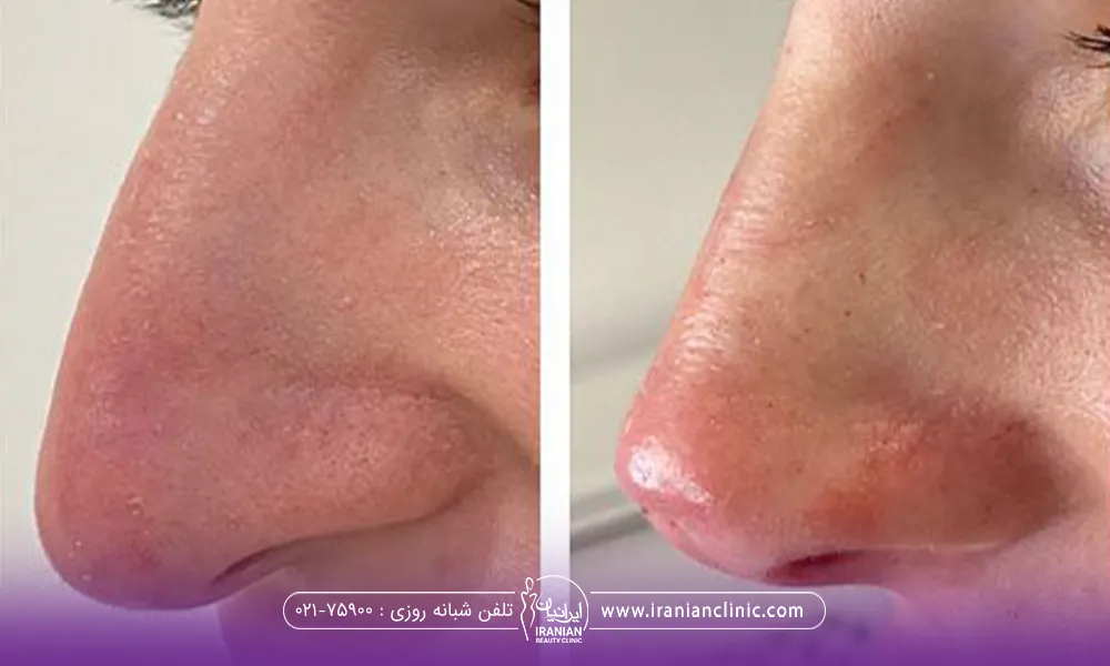 عکس قبل و بعد از لیفت نخ بینی فرد