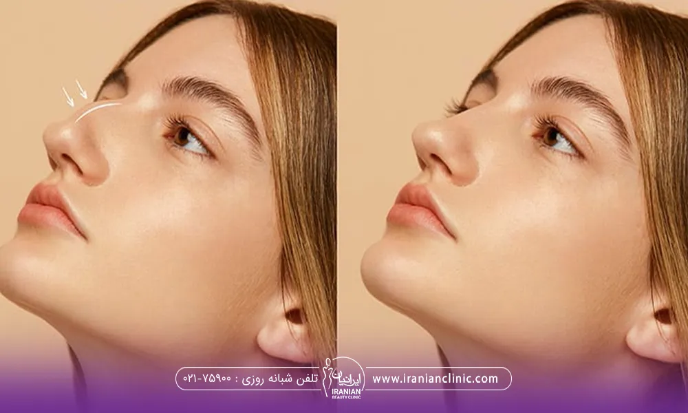 عکس قبل و بعد رفع قوز بینی دختر جوان
