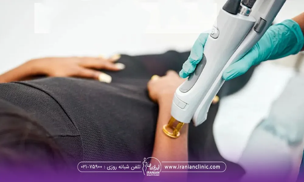 اپراتور که با هندپیس دستگاه کندلا دست مراجعه کننده خانم را لیزر می کند
