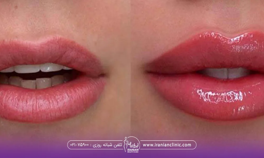 عکس قبل و بعد از لبهای دختر که تزریق ژل انجام داده است