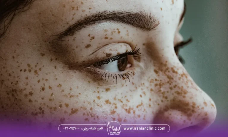صورت دختر جوان که پر از کک و مک است - درمان کک و مک