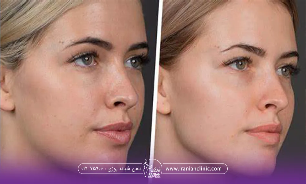 عکس قبل و بعد دختری که زاویه سازی صورت انجام داده است