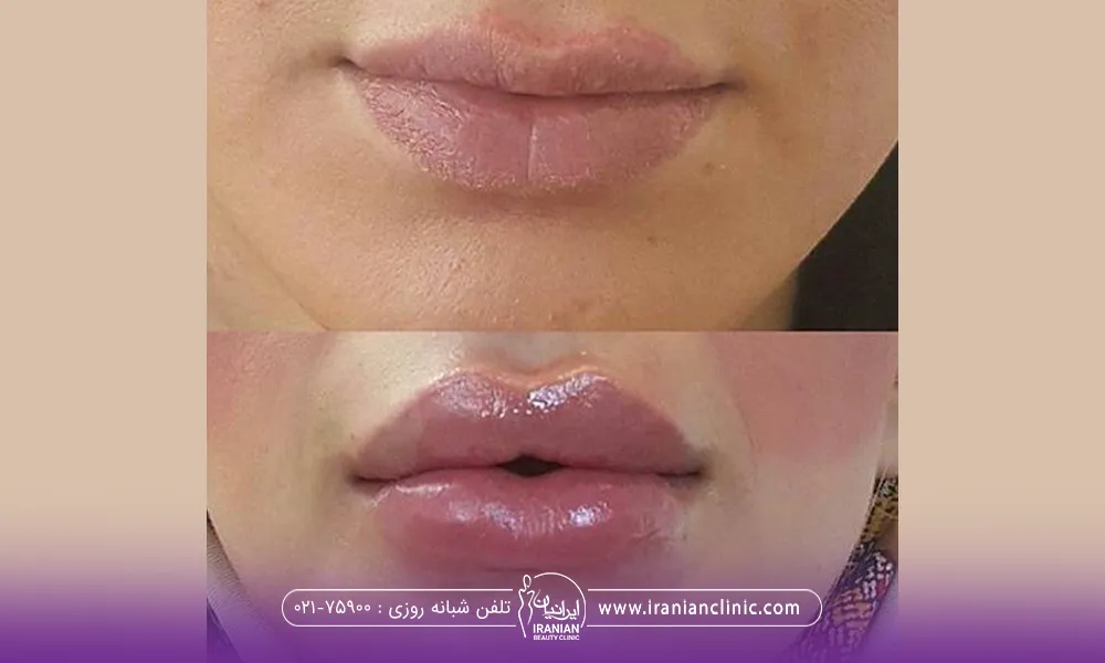 قبل و بعد فردی که تزریق ژل لب انجام داده است و لبهای او اردکی شده است - تزریق ژل لب اردکی