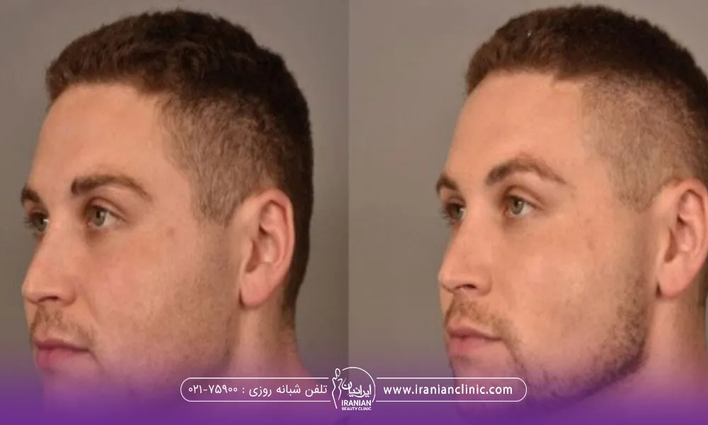 عکس قبل و بعد بوکال فت مرد جوان