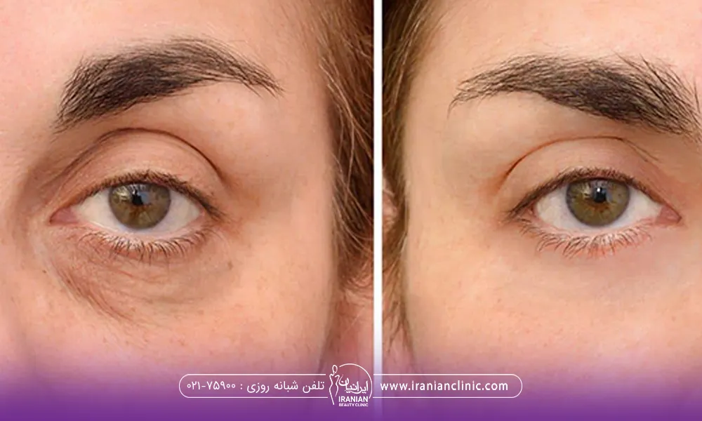 کاربرد تزریق بوتاکس دور چشم