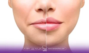 قبل و بعد فردی که سانترال لب انجام داده است