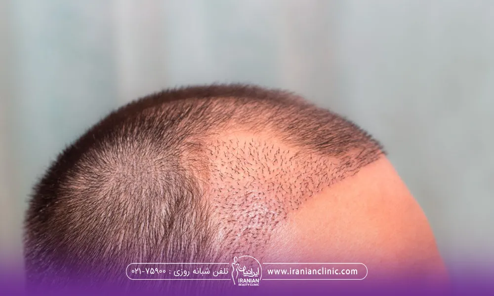 مردی که در ناحیه شقیقه سر کاشت مو انجام داده است
