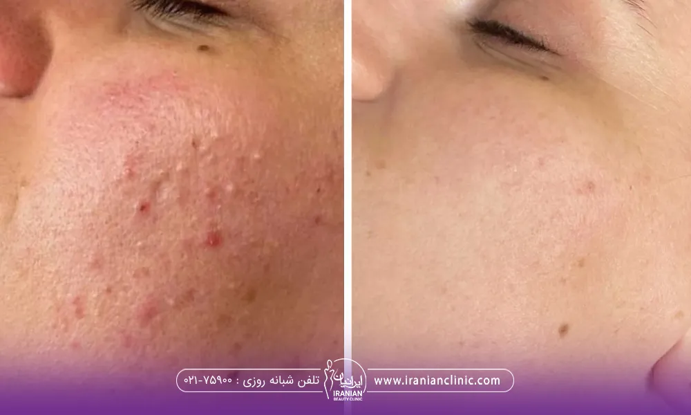 عکس قبل و بعد صورت دختری که جوش داشته و با میکرونیدلینگ صورت جای جوش او از بین رفته است