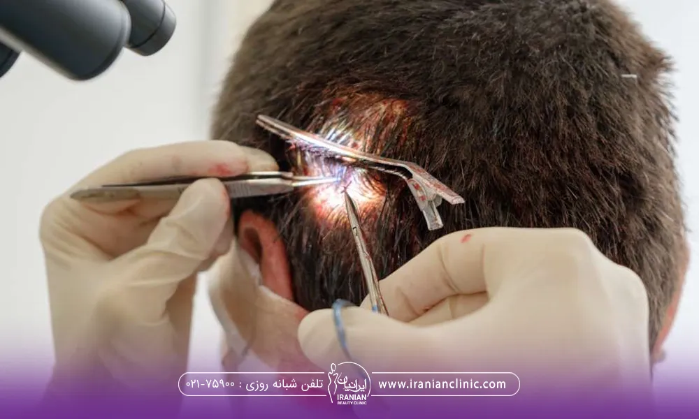 دستان دکتری که در حال انجام کاشت مو در قسمت پشت سر فرد است
