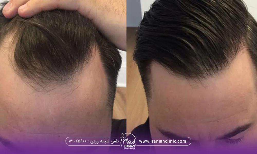 عکس قبل و بعد کاشت مو در ناحیه شقیقه مرد جوان