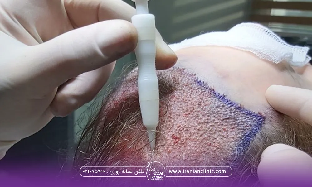 فردی که خوابیده و دکتری که بالای سرش در حال انجام کاشت مو میباشد