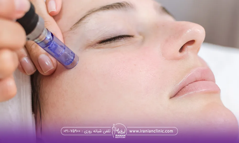 صورت دختر با پوست صاف و جوان که فردی دستگاه میکرونیدلینگ را روی گونه او گذاشته است - مراقبت های بعد از میکرونیدلینگ