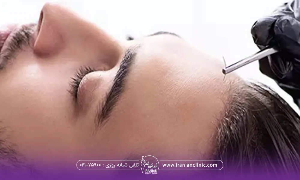 مردی که دراز کشیده است و دستان دکتری که در حال کاشت مو می باشد