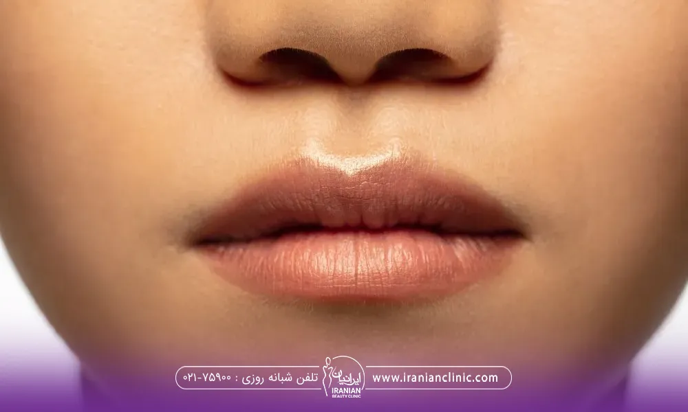لبهای دختر که لب بالای او حجیم است