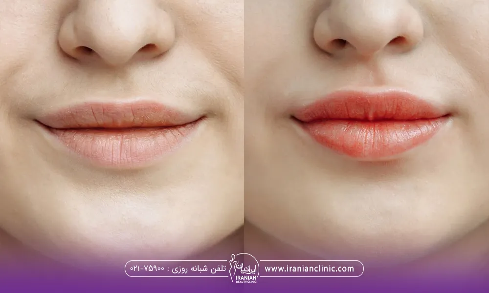 عکس قبل و بعد دختری که شیدینگ لب انجام داده است