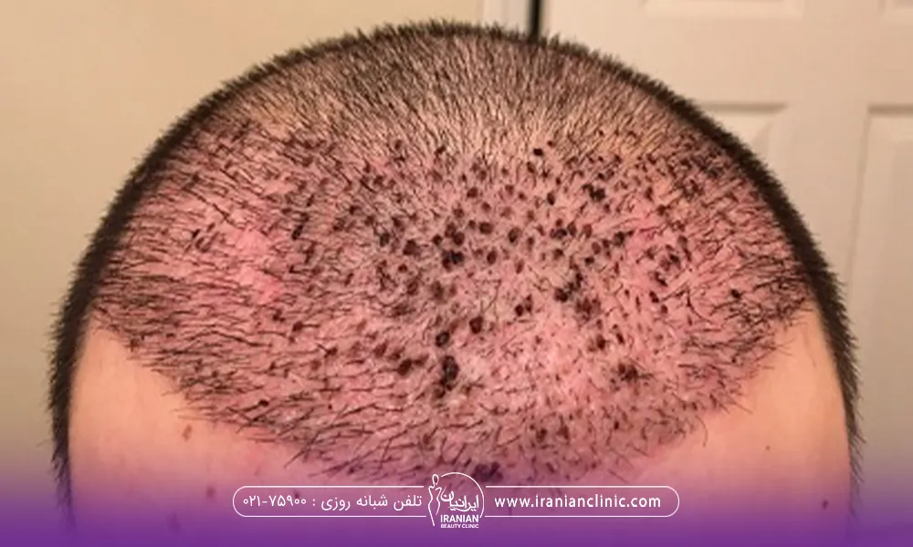 مردی که کاشت مو انجام داده است و روی سرش دلمه ایجاد شده است