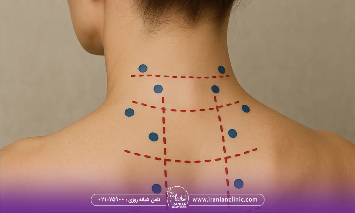نقاط تزریق بوتاکس در گردن