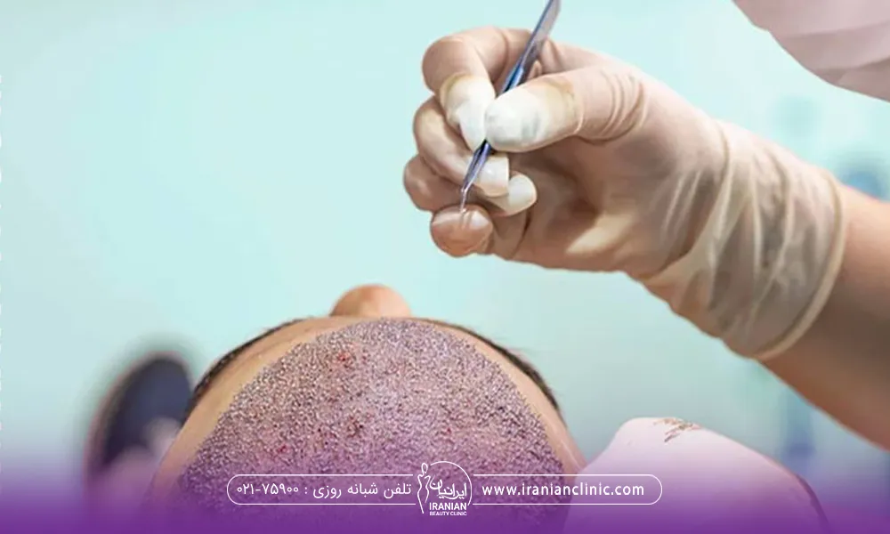 فردی که خوابیده و دست دکتر که در حال انجام کاشت مو است - کله پاچه بعد از کاشت مو
