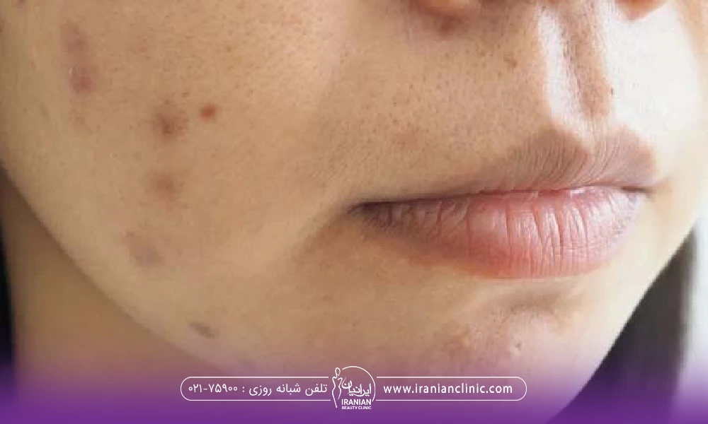 دختری که لکه های قهوه ای روی صورتش ایجاد شده است