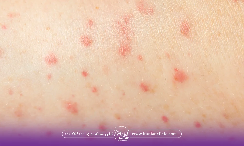 پوستی که روی آن جوش های متعددی وجود دارد - خارش بعد از لیزر موهای زائد​