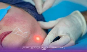 فردی که خوابیده و عینک مخصوص زده و دستان دکتر که در حال انجام اندولیفت گردن است - اندولیفت در شرق تهران