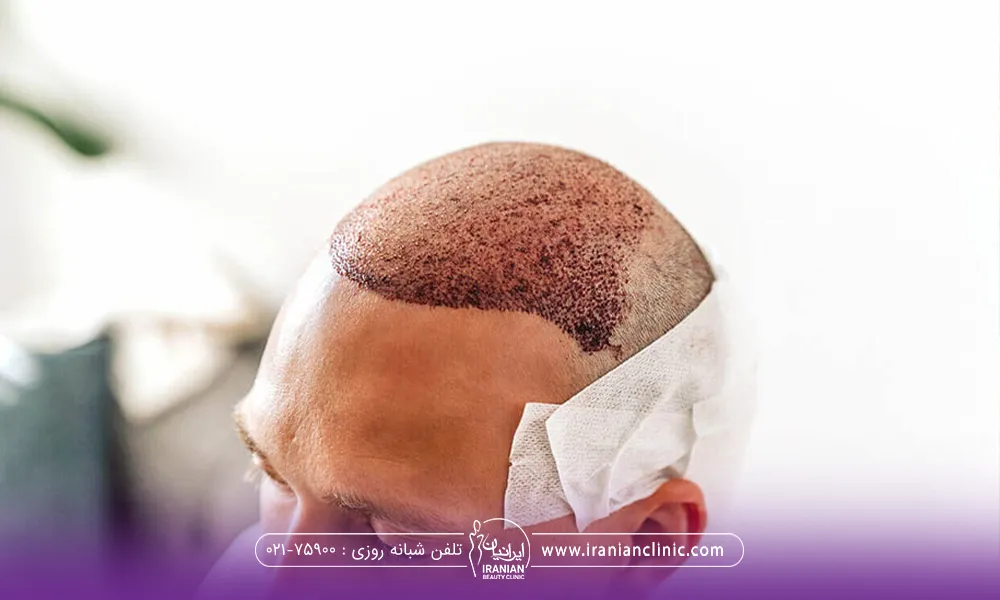 سر مردی که کاشت انجام داده است و پشت سرش را با باند بسته است