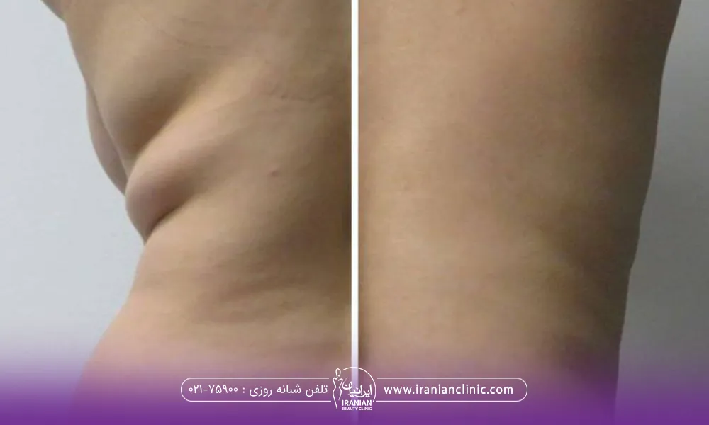 قبل و بعد فردی که فیله های خودرا با دستگاه کوتیشن لاغر کرده است-هزینه لاغری با دستگاه کویتیشن