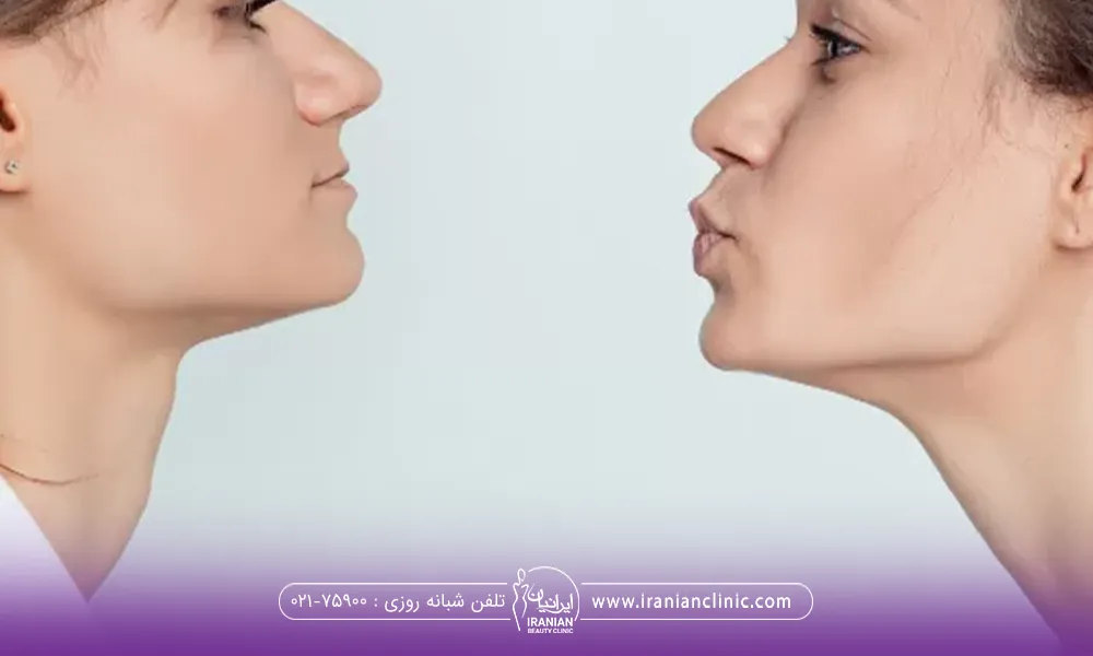 دو زن که روبروی هم ایستاده اند که دختر سمت راست لب های غنچه کرده است به منظور اینکه تمرین زاویه فک انجام دهد