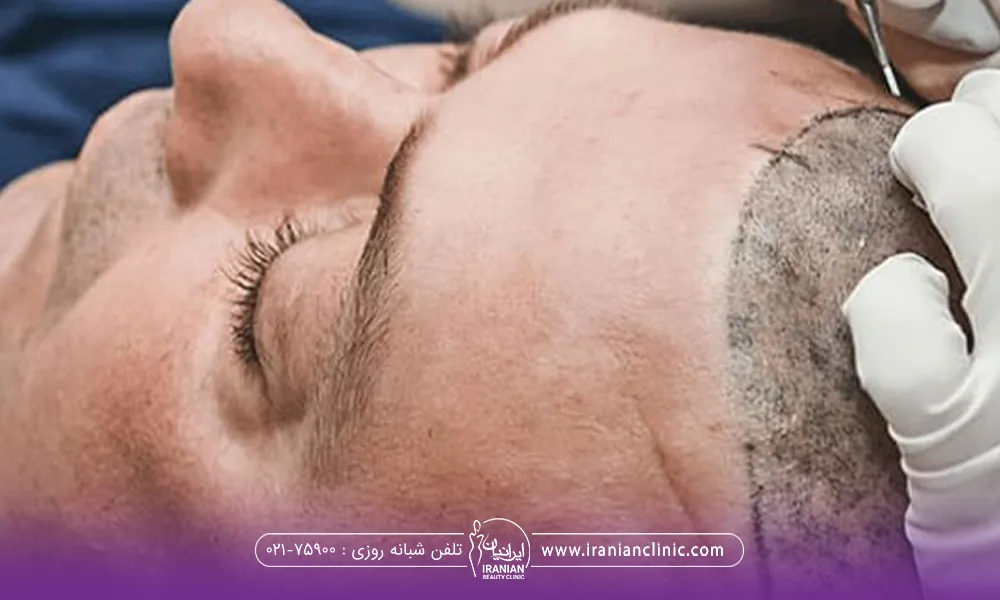 دست دکتری که در حال کاشت مو روی سر فرد است