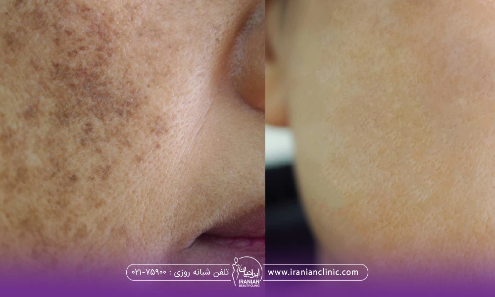 عکس قبل و بعد از کسی که بعد از لیزر صورتش دچار لکه های قهوه ای شده است