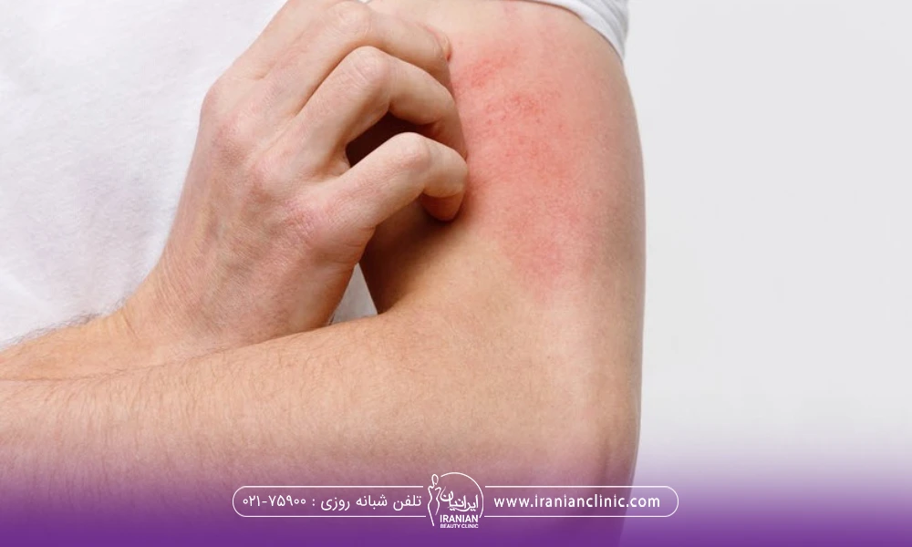 عکس فردی که در حال خاراندن بازوی خود است