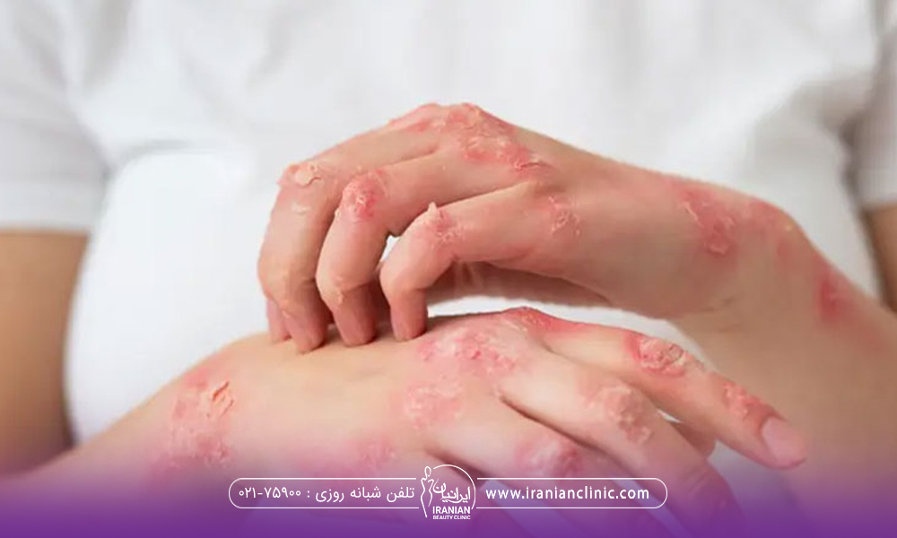 فردی که روی هر دو دست جوش های ملتهب دارد و در حال خاراندن دستش است