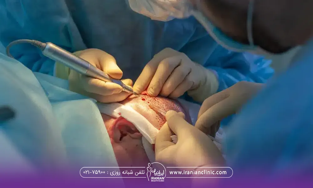 دکتر هایی که مشغول کاشت مو روی سر فرد می باشند و لباس و دستکش مخصوص دارند