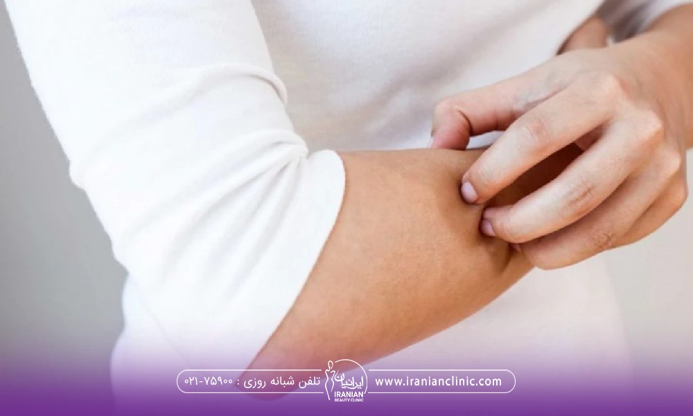 فردی که دستش میخارد و با دست دیگر در حال خاراندن دستش است