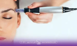نیمرخ فردی که چشم هایش بسته است و دست اپراتوری که در حال انجام Microneedling است - هزینه میکرونیدلینگ