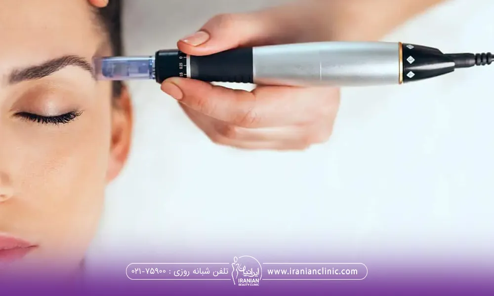 نیمرخ فردی که چشم هایش بسته است و دست اپراتوری که در حال انجام Microneedling است - هزینه میکرونیدلینگ