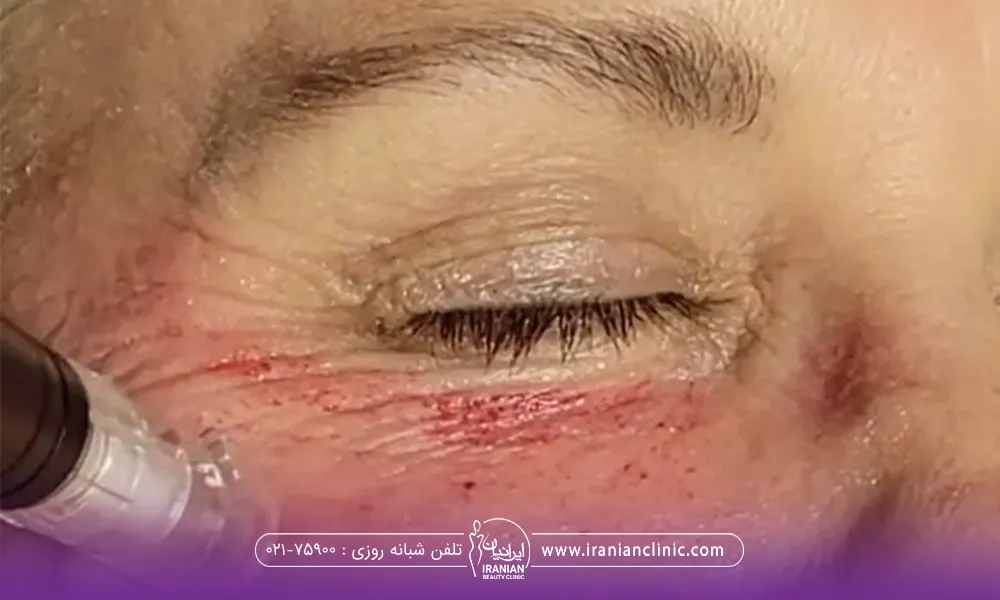 فردی که چشم هایش بسته است و زیر چشمش بخاطر استفاده از درماپن قرمز شده است