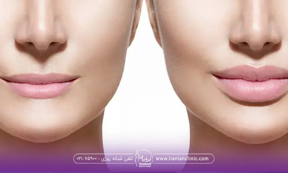 عکس قبل و بعد دختری که تزریق ژل لب انجام داده است