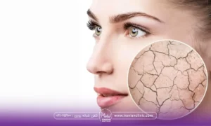 نیمرخ خانمی که به یک سمت نگاه می کند و یک دایره روی صورتش است که خشکی پوست را نشان میدهد