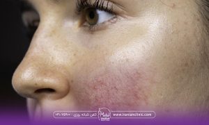 نیم رخ دختری که گونه اش کبود شده - عوارض تزریق ژل گونه