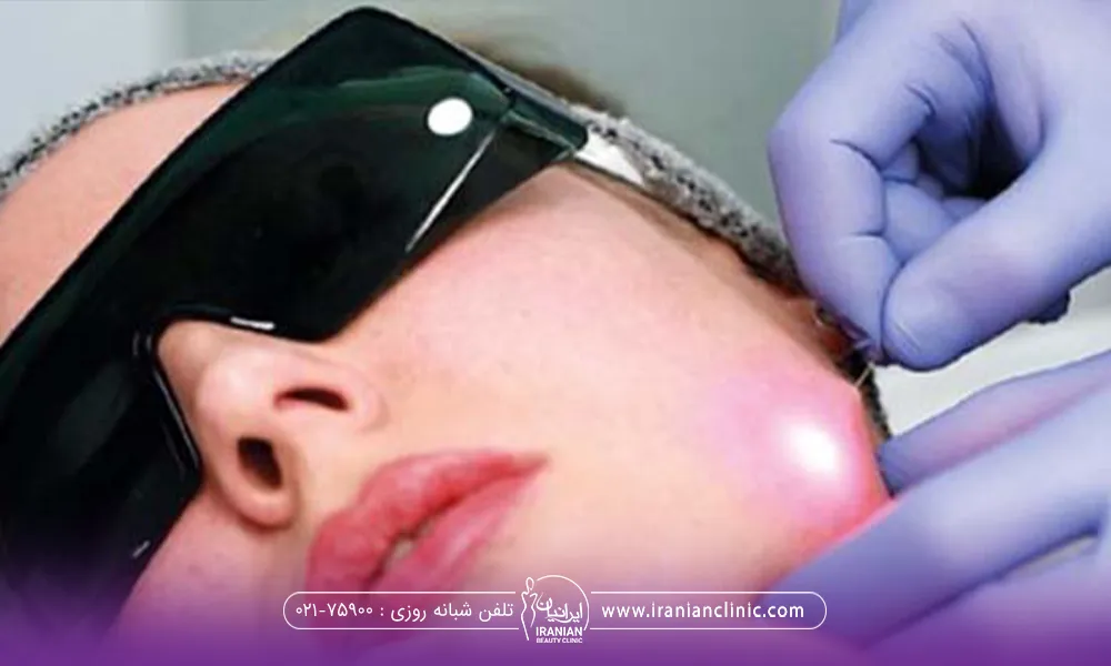 فردی که خوابیده و عینک مشکی مخصوص زده و دستان دکتر با دستکش آبی در حال انجام اندولیفت