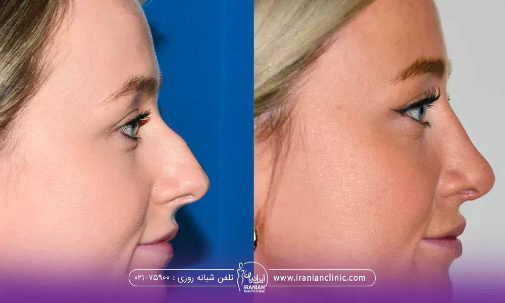 عکس قبل و بعد زنی که عمل بینی انجام داده است