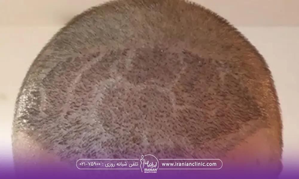 سر مردی که کاشت مو انجام داده است و بعد از کاشت پوست سر او ترک ترک شده است