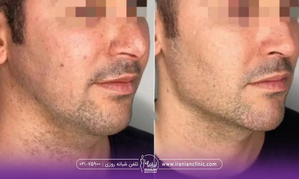 عکس قبل و بعد مردی که زاویه سازی فک انجام داده است