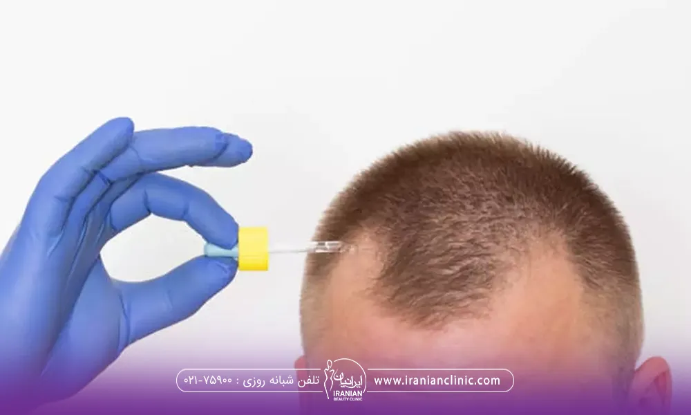 فردی که دستکش آبی به دست دارد و یک قطره چکان در دست دارد که نزدیک سرش کرده است-اسپری ماینوکسیدیل بعد از کاشت مو